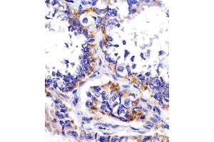 (ABIN390207 and ABIN2840690) staining DDIT4 in human lung adenocarcinoma tissue sections by Immunohistochemistry (IHC-P - paraformaldehyde-fixed, paraffin-embedded sections). (DDIT4 antibody  (N-Term))