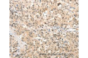 Immunohistochemistry of Human breast cancer using TSPYL2 Polyclonal Antibody at dilution of 1:30
