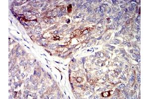 Immunohistochemical analysis of paraffin-embedded bladder cancer tissues using P2RY4 mouse mAb with DAB staining. (P2RY4 antibody)