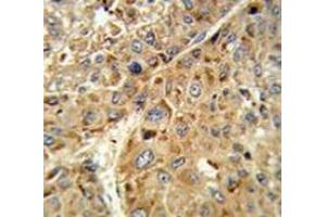 Immunohistochemistry analysis of human hepatocarcinoma tissue (Formalin-fixed, Paraffin-embedded) using Glutathione peroxidase 1 / GPX1  Antibody (C-term), followed by peroxidase-conjugated secondary antibody and DAB staining. (Glutathione Peroxidase 1 antibody  (C-Term))