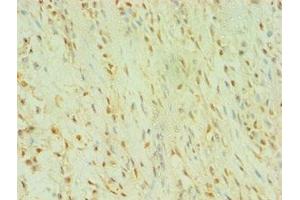 Immunohistochemistry of paraffin-embedded human breast cancer using ABIN7174010 at dilution of 1:100 (BLK antibody  (AA 1-280))