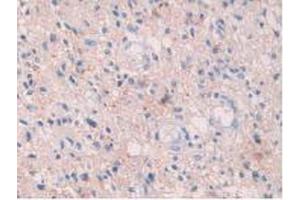 IHC-P analysis of Human Glioma Tissue, with DAB staining. (HIF1A antibody  (AA 218-506))