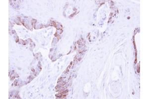 IHC-P Image Immunohistochemical analysis of paraffin-embedded CA922 xenograft , using LIM kinase 2, antibody at 1:500 dilution. (LIMK2 antibody)