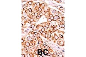 Formalin-fixed and paraffin-embedded human cancer tissue reacted with the primary antibody, which was peroxidase-conjugated to the secondary antibody, followed by AEC staining. (PIKFYVE antibody  (AA 1531-1561))