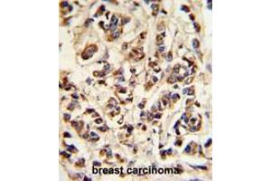 ATP6V1A Antibody (Center) IHC analysis in formalin fixed and paraffin embedded breast carcinoma followed by peroxidase conjugation of the secondary antibody and DAB staining. (ATP6V1A antibody  (Middle Region))