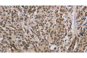 Immunohistochemistry of paraffin-embedded Human esophagus cancer using IRF9 Polyclonal Antibody at dilution of 1:50 (IRF9 antibody)