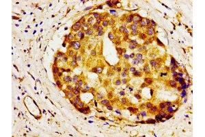 Immunohistochemistry of paraffin-embedded human breast cancer using ABIN7143782 at dilution of 1:100 (A1BG antibody  (AA 284-408))