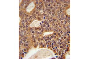 DCLRE1B Antibody immunohistochemistry analysis in formalin fixed and paraffin embedded human prostate carcinoma followed by peroxidase conjugation of the secondary antibody and DAB staining. (DCLRE1B antibody  (AA 208-236))