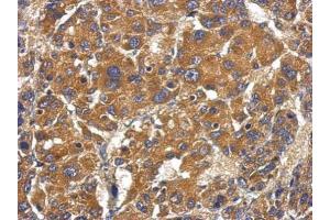 IHC-P Image Immunohistochemical analysis of paraffin-embedded human hepatoma, using Factor B, antibody at 1:500 dilution. (Complement Factor B antibody)