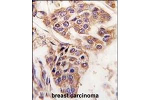 Formalin-fixed and paraffin-embedded human breast carcinoma tissue reacted with C8orf32 antibody (Center), which was peroxidase-conjugated to the secondary antibody, followed by DAB staining. (WDYHV1 antibody  (AA 106-136))