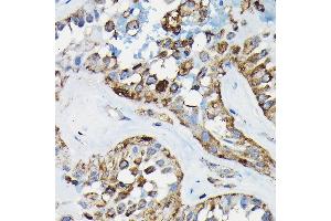 Immunohistochemistry of paraffin-embedded human thyroid cancer using PRC1 Rabbit pAb (ABIN6128502, ABIN6146124, ABIN6146125 and ABIN6222808) at dilution of 1:100 (40x lens). (PRC1 antibody  (AA 351-620))