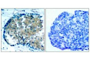 Immunohistochemical analysis of paraffin-embedded human breast carcinoma tissue using Ezrin(Phospho-Tyr353) Antibody(left) or the same antibody preincubated with blocking peptide(right). (Ezrin antibody  (pTyr353))