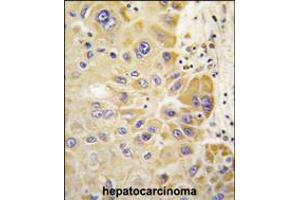Formalin-fixed and paraffin-embedded human hepatocarcinoma tissue reacted with ALDH2 antibody , which was peroxidase-conjugated to the secondary antibody, followed by DAB staining. (ALDH2 antibody  (AA 318-347))