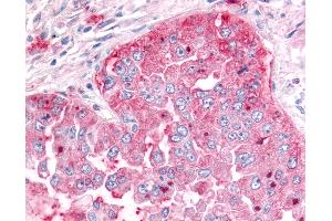 Anti-ADAMTS5 antibody IHC of human Lung, Non-Small Cell Carcinoma. (ADAMTS5 antibody  (C-Term))