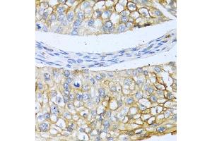 Immunohistochemistry of paraffin-embedded human prostate cancer using BMP4 antibody (ABIN5997308) at dilution of 1/100 (40x lens). (BMP4 antibody)