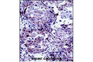 CTTN Antibody (Center) (ABIN657649 and ABIN2846644) immunohistochemistry analysis in formalin fixed and paraffin embedded human breast carcinoma followed by peroxidase conjugation of the secondary antibody and DAB staining. (Cortactin antibody  (AA 273-302))