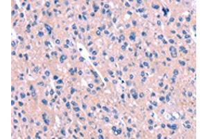 The image on the left is immunohistochemistry of paraffin-embedded Human liver cancer tissue using ABIN7190562(ENPP4 Antibody) at dilution 1/15, on the right is treated with synthetic peptide. (ENPP4 antibody)