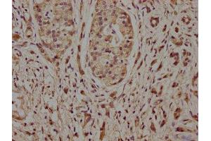 IHC image of ABIN7161559 diluted at 1:100 and staining in paraffin-embedded human pancreatic cancer performed on a Leica BondTM system. (Nicalin antibody  (AA 214-522))