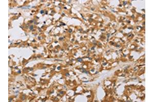 The image on the left is immunohistochemistry of paraffin-embedded Human thyroid cancer tissue using ABIN7130805(RAD54L2 Antibody) at dilution 1/40, on the right is treated with fusion protein. (ARIP4 antibody)