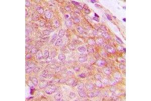 Immunohistochemical analysis of CHKB staining in human breast cancer formalin fixed paraffin embedded tissue section. (CHKB antibody  (C-Term))