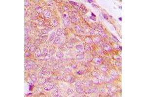 Immunohistochemical analysis of CHKB staining in human breast cancer formalin fixed paraffin embedded tissue section.
