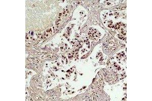 Immunohistochemical analysis of CREB staining in human lung cancer formalin fixed paraffin embedded tissue section. (CREB1 antibody)