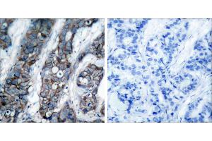 Immunohistochemical analysis of paraffin- embedded human breast carcinoma tissue, using HER2 (phospho-Tyr1248) antibody. (ErbB2/Her2 antibody  (pTyr1248))