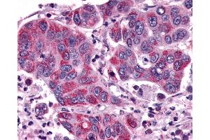 Anti-ACKR3 / CXCR7 / RDC1 antibody IHC of human Colon, Carcinoma. (CXCR7 antibody  (Cytoplasmic Domain))