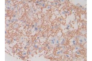 IHC-P analysis of Human Glioma Tissue, with DAB staining. (MBP antibody  (AA 135-190))