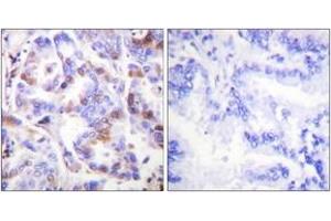 Immunohistochemistry analysis of paraffin-embedded human lung carcinoma, using RFA2 (Phospho-Thr21) Antibody. (RPA2 antibody  (pThr21))