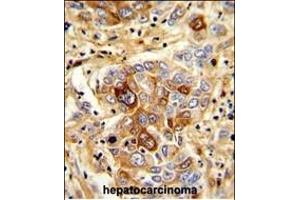 Formalin-fixed and paraffin-embedded human hepatocarcinoma with C Antibody (N-term), which was peroxidase-conjugated to the secondary antibody, followed by DAB staining. (CD163 antibody  (N-Term))