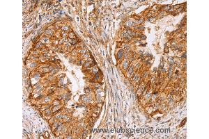 Immunohistochemistry of Human cervical cancer using CD59 Polyclonal Antibody at dilution of 1:50 (CD59 antibody)