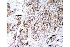 IHC-P: VE-Cadherin antibody testing of human lung cancer tissue (Cadherin 5 antibody  (AA 766-784))
