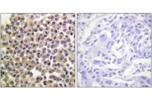 Immunohistochemistry analysis of paraffin-embedded human breast carcinoma, using p130 Cas (Phospho-Tyr249) Antibody. (BCAR1 antibody  (pTyr249))