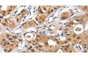 Immunohistochemistry of paraffin-embedded Human lung cancer using 14-3-3 epsilon Polyclonal Antibody at dilution of 1:100