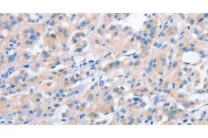 Immunohistochemistry of paraffin-embedded Human thyroid cancer using NCAPD2 Polyclonal Antibody at dilution of 1:40 (NCAPD2 antibody)