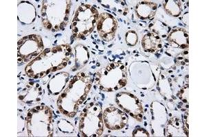 Immunohistochemical staining of paraffin-embedded Adenocarcinoma of ovary tissue using anti-CISD1mouse monoclonal antibody. (CISD1 antibody)