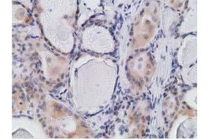 Immunohistochemical staining of paraffin-embedded Carcinoma of Human thyroid tissue using anti-RBBP9 mouse monoclonal antibody. (RBBP9 antibody)