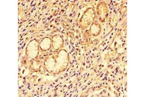 Immunohistochemistry of paraffin-embedded human gastric cancer using ABIN7146019 at dilution of 1:100 (CCL8 antibody  (AA 24-99))