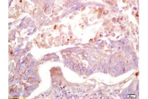 Formalin-fixed and paraffin embedded human lung carcinoma labeled with Anti-MAS1L Polyclonal Antibody, Unconjugated (ABIN759926) at 1:200 followed by conjugation to the secondary antibody and DAB staining. (MAS1L antibody  (AA 201-300))