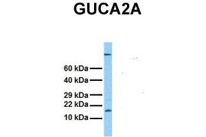 Host:  Rabbit  Target Name:  GUCA2A  Sample Tissue:  Human Stomach Tumor  Antibody Dilution:  1. (GUCA2A antibody  (Middle Region))