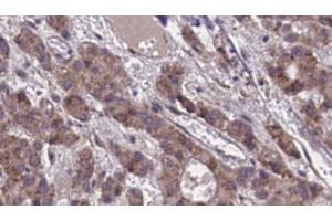 ABIN6273873 at 1/100 staining Human liver cancer tissue by IHC-P. (GPR39 antibody  (C-Term))
