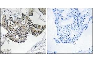 Immunohistochemistry analysis of paraffin-embedded human breast carcinoma tissue, using RSAD1 Antibody.