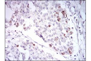 Immunohistochemical analysis of paraffin-embedded ovarian cancer tissues using TERF2 mouse mAb with DAB staining. (TRF2 antibody  (AA 324-500))