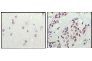 Immunohistochemical analysis of paraffin-embedded human cerebra (left) and breast carcinoma tissue (right), showing nuclear location with DAB staining using NCOR1 antibody. (NCOR1 antibody  (AA 1-192))