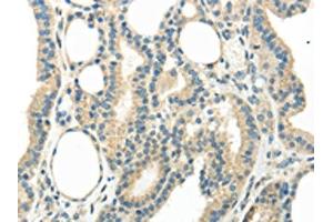 The image on the left is immunohistochemistry of paraffin-embedded Human thyroid cancer tissue using ABIN7193067(WNT6 Antibody) at dilution 1/35, on the right is treated with synthetic peptide. (WNT6 antibody)