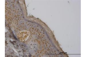 Immunoperoxidase of monoclonal antibody to FBXO11 on formalin-fixed paraffin-embedded human melanoma. (FBXO11 antibody  (AA 744-843))