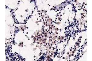 Immunohistochemical staining of paraffin-embedded Carcinoma of Human lung tissue using anti-OSBPL11 mouse monoclonal antibody. (OSBPL11 antibody)