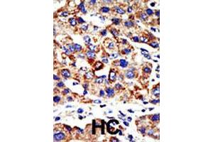 Formalin-fixed and paraffin-embedded human hepatocellular carcinoma tissue reacted with the HDAC8 polyclonal antibody  , which was peroxidase-conjugated to the secondary antibody, followed by AEC staining. (HDAC8 antibody  (N-Term))
