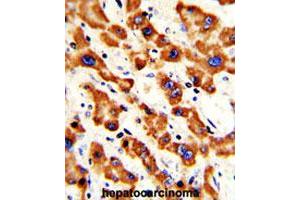 Formalin-fixed and paraffin-embedded human hepatocarcinomareacted with PHB polyclonal antibody , which was peroxidase-conjugated to the secondary antibody, followed by AEC staining. (Prohibitin antibody  (AA 99-129))